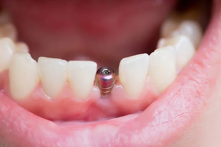 What Makes Dental Implants Better Than Other Tooth Replacement Options
