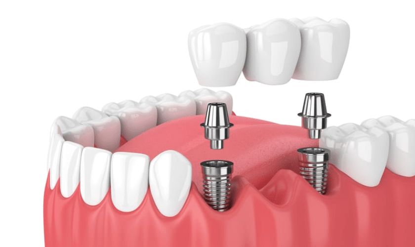 Dental Implants: Bridging The Gap to A Confident Smile