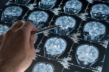 Tumori cerebrali in costante aumento, 6.100 nuovi casi nel 2020