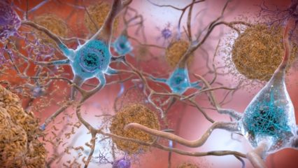 Alzheimer, una nuova molecola rallenta la malattia