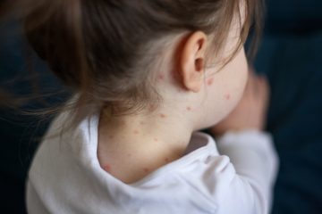 Morbillo, a giugno 1.891 casi in Europa e 150 in Italia