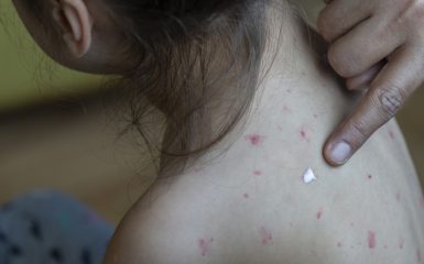 Morbillo: 89 casi a luglio, 807 dall'inizio dell'anno