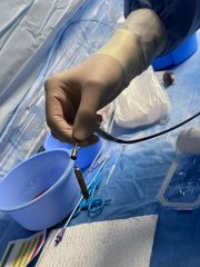 All'ospedale di Fermo impiantato nuovo pacemaker senza fili