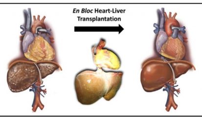 Cuore e fegato trapiantati in blocco come un unico organo, la prima volta in Italia