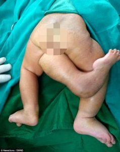 La bimba nata con tre gambe