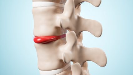 Ernia intervertebrale, sintomi, diagnosi, trattamento