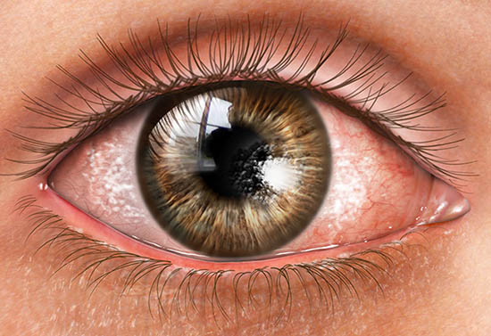Dry Eye Syndrome Market Size, Growth, Trends Report 2024-32