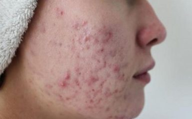 Seborax siero anti acne recensioni, funziona, prezzo, opinioni, in farmacia