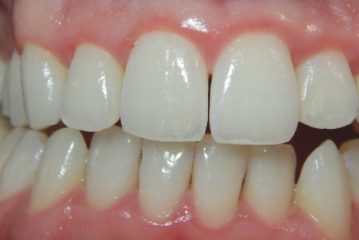 Gomma bianca sotto il dente - cause