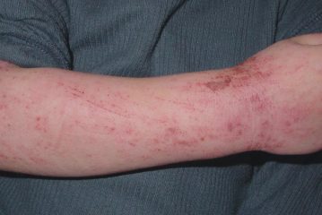 Eczema in un bambino, prevenzione, cura e pulizia
