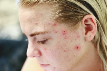 Trattamento dell'acne cistica