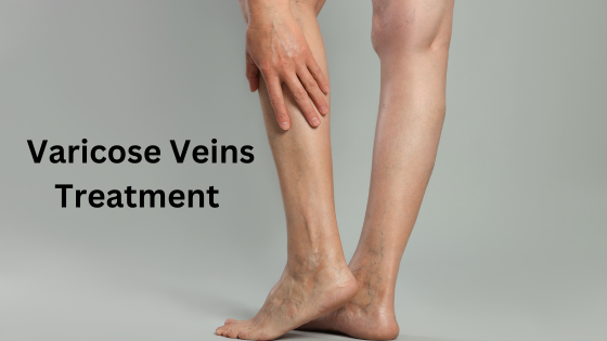 Preparing Yourself for Varicose Vein Treatment: A Step-by-Step Guide