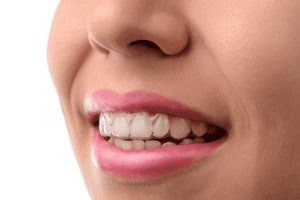 Invisalign-Cost-Santa-MonicaBeverly-Hills-Invisalign-Los-Angeles