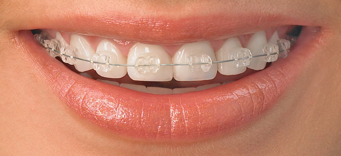 Straighten Your Smile, Straighten Your Confidence: Exploring Braces Options in Nagpur (