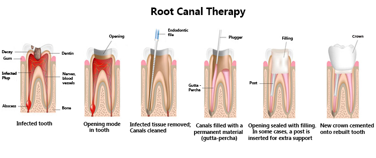 Save Your Smile, Save the Pain: Exploring Root Canal Treatment in Nagpur