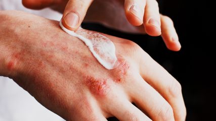 Vivere con l'eczema