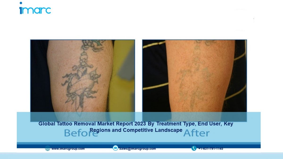 Tattoo Removal Market Size 2023 | Industry Growth Report, 2028