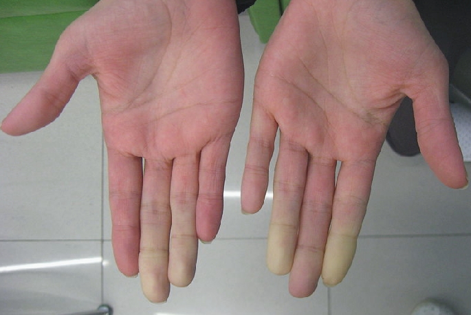 Come trattare la malattia di Raynaud, la sua connessione con la sindrome dell'intestino permeabile